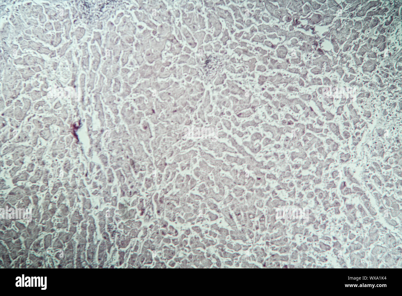 Leber mit Hepatitis Marker krankes Gewebe unter dem Mikroskop 100x Stockfoto