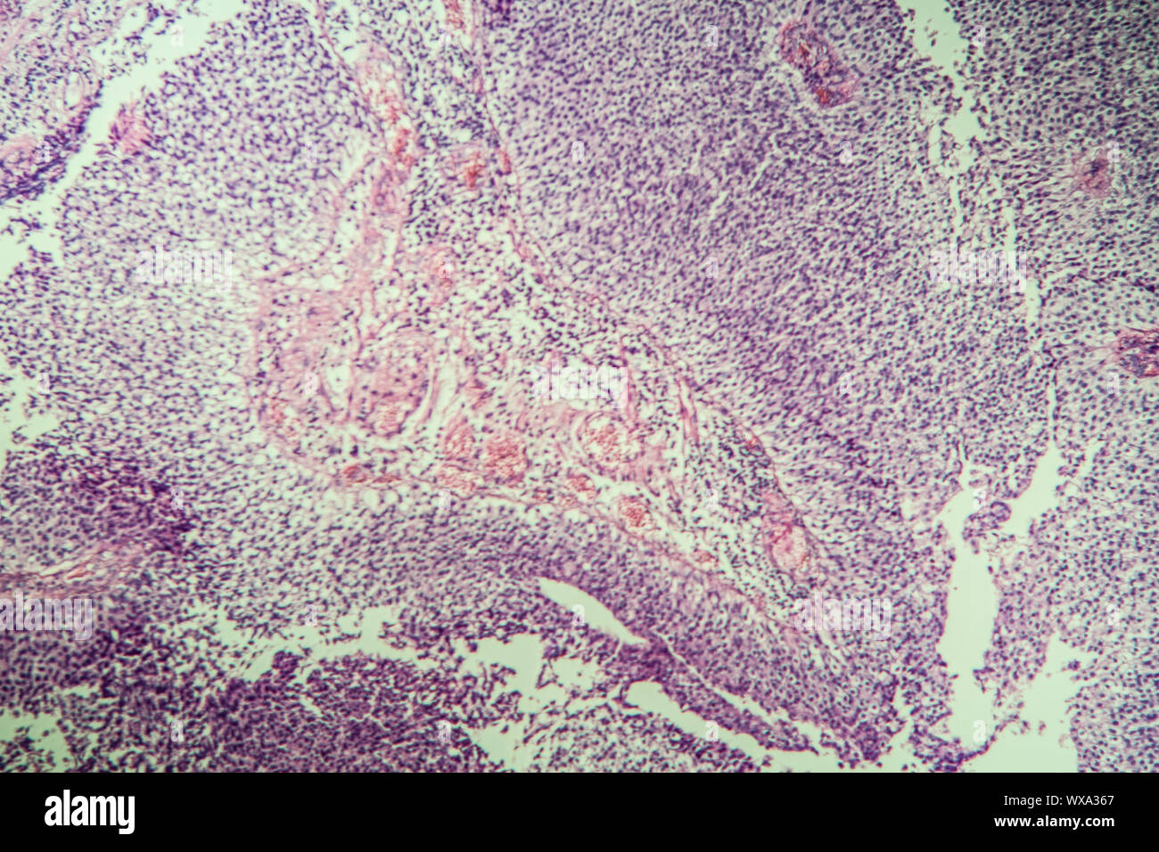 Blasen papillioma krankes Gewebe unter dem Mikroskop 100x Stockfoto