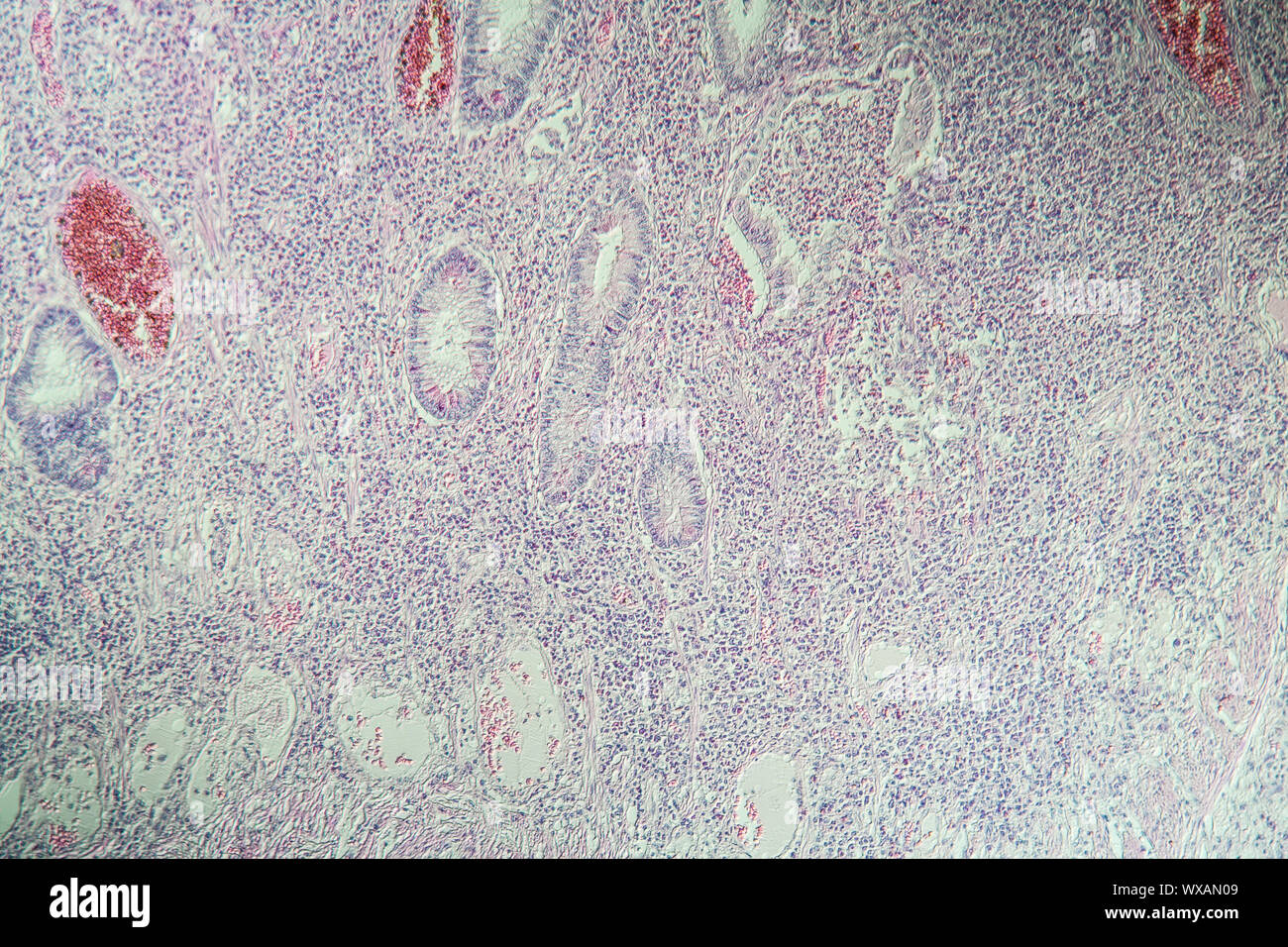 Morbus Crohn intestinale Entzündung unter dem Mikroskop 100x Stockfoto