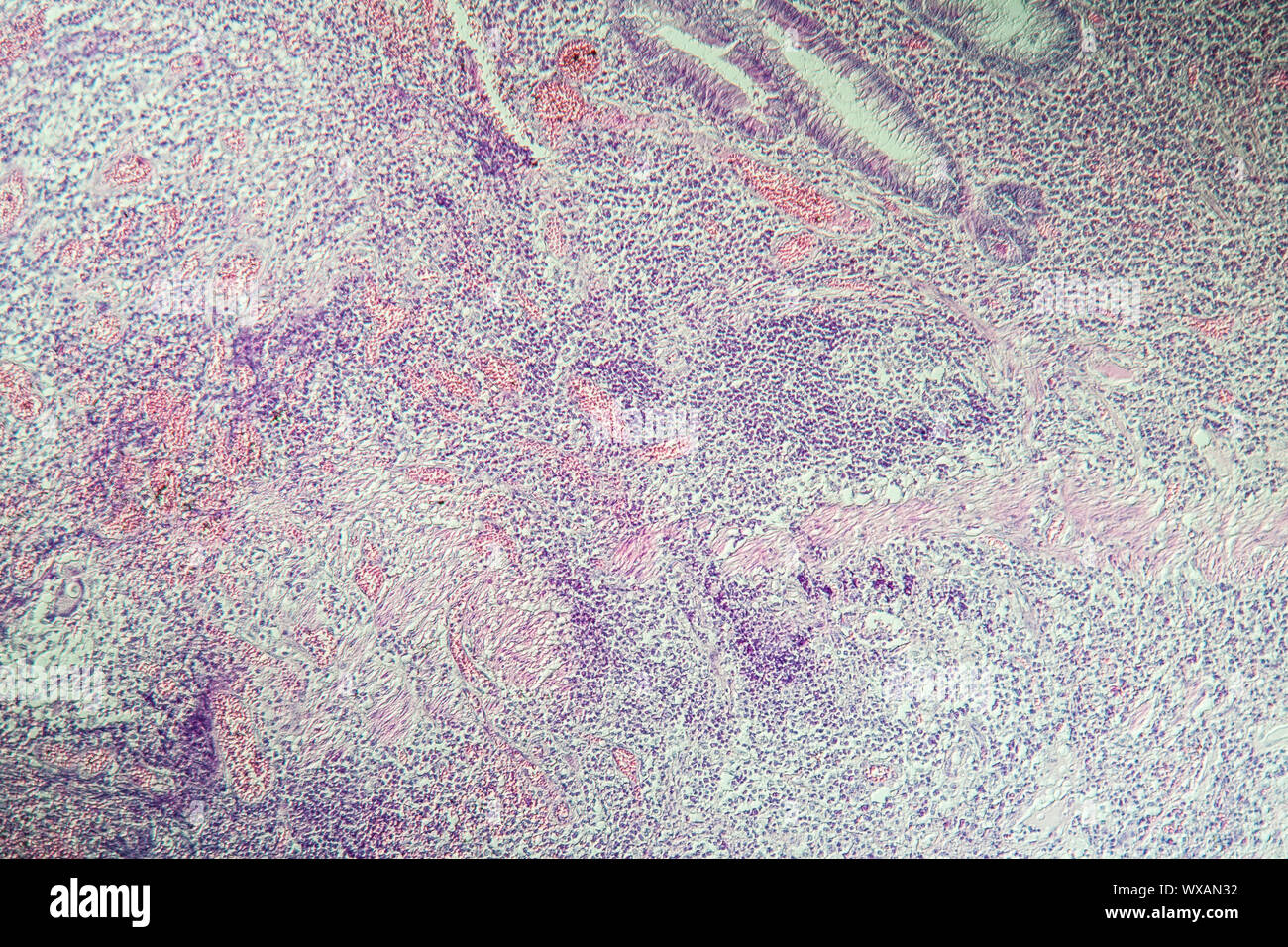 Morbus Crohn intestinale Entzündung unter dem Mikroskop 100x Stockfoto