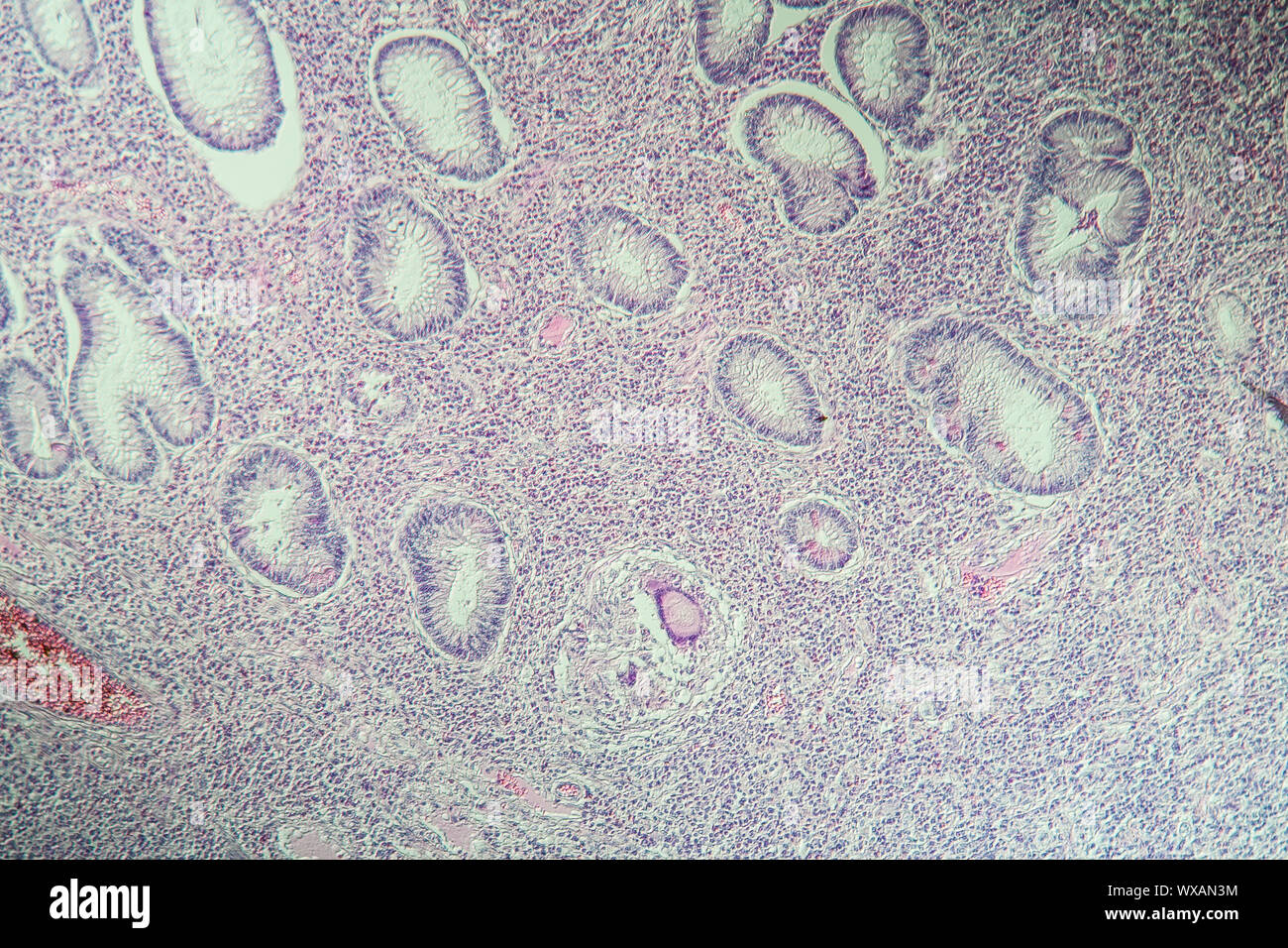 Morbus Crohn intestinale Entzündung unter dem Mikroskop 100x Stockfoto