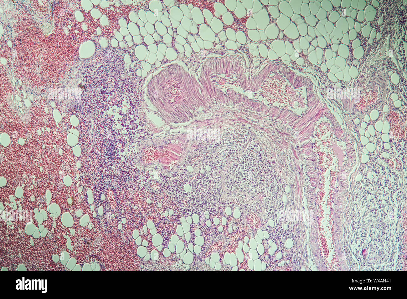 Morbus Crohn intestinale Entzündung unter dem Mikroskop 100x Stockfoto