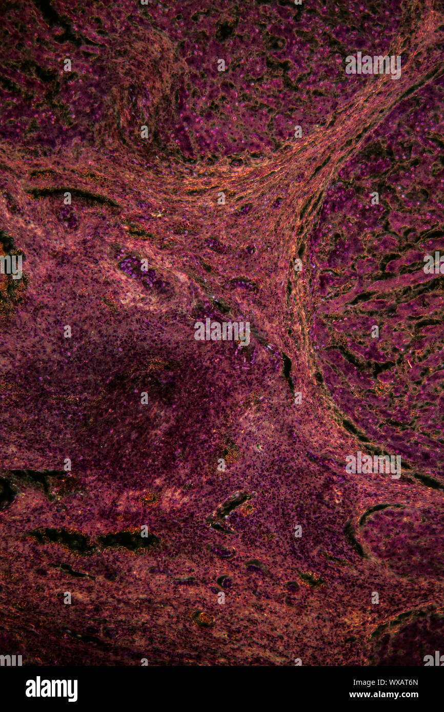 Leber entzündung im dunklen Bereich unter dem Mikroskop 100x Stockfoto