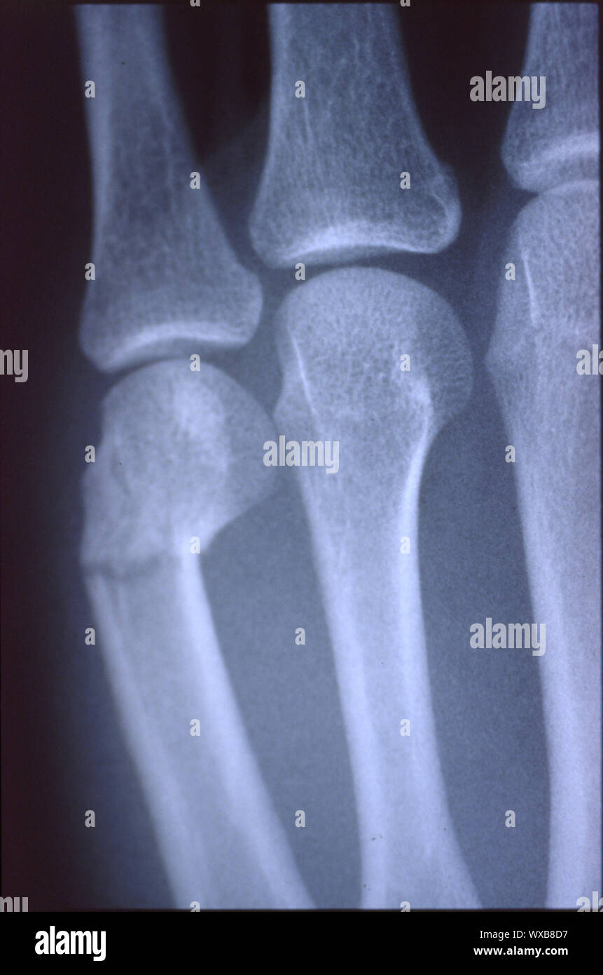 X-ray Bild, Mann, Hand Stockfoto