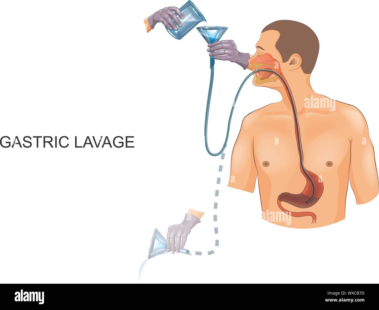 Vector Illustration der Magenspülung mit einer Magensonde Stock Vektor