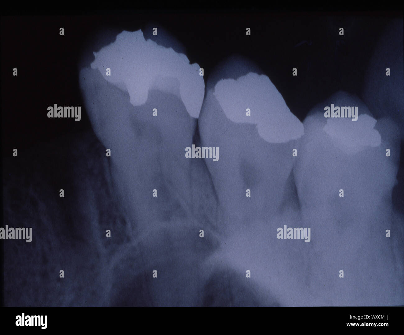 X-ray der Zähne mit Füllungen und Brücken Stockfoto