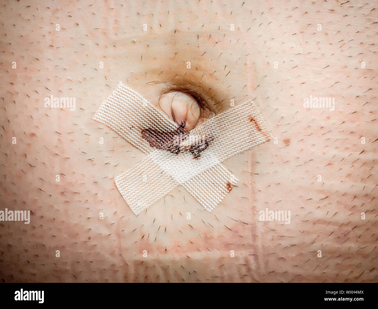 Eine wunde Nabelbruch drei Tage nach der Operation mit Gips Stockfotografie Alamy