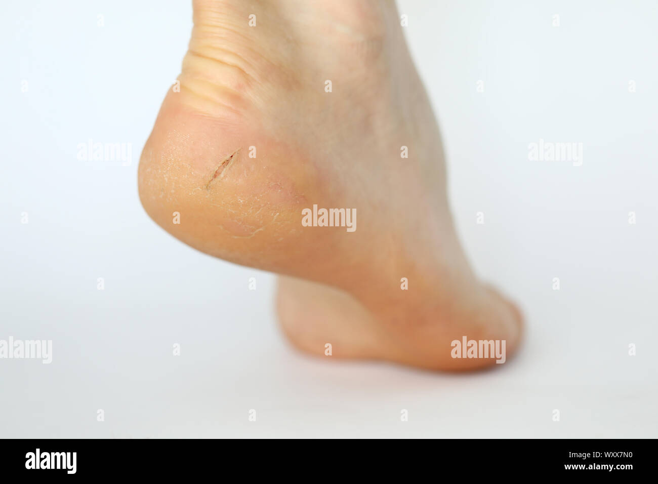 Rissige haut bein -Fotos und -Bildmaterial in hoher Auflösung – Alamy