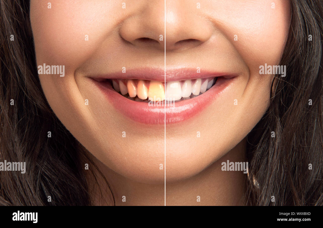 Nahaufnahme der lächelnde Frau Zähne vor und nach dem Bleichen Stockfoto