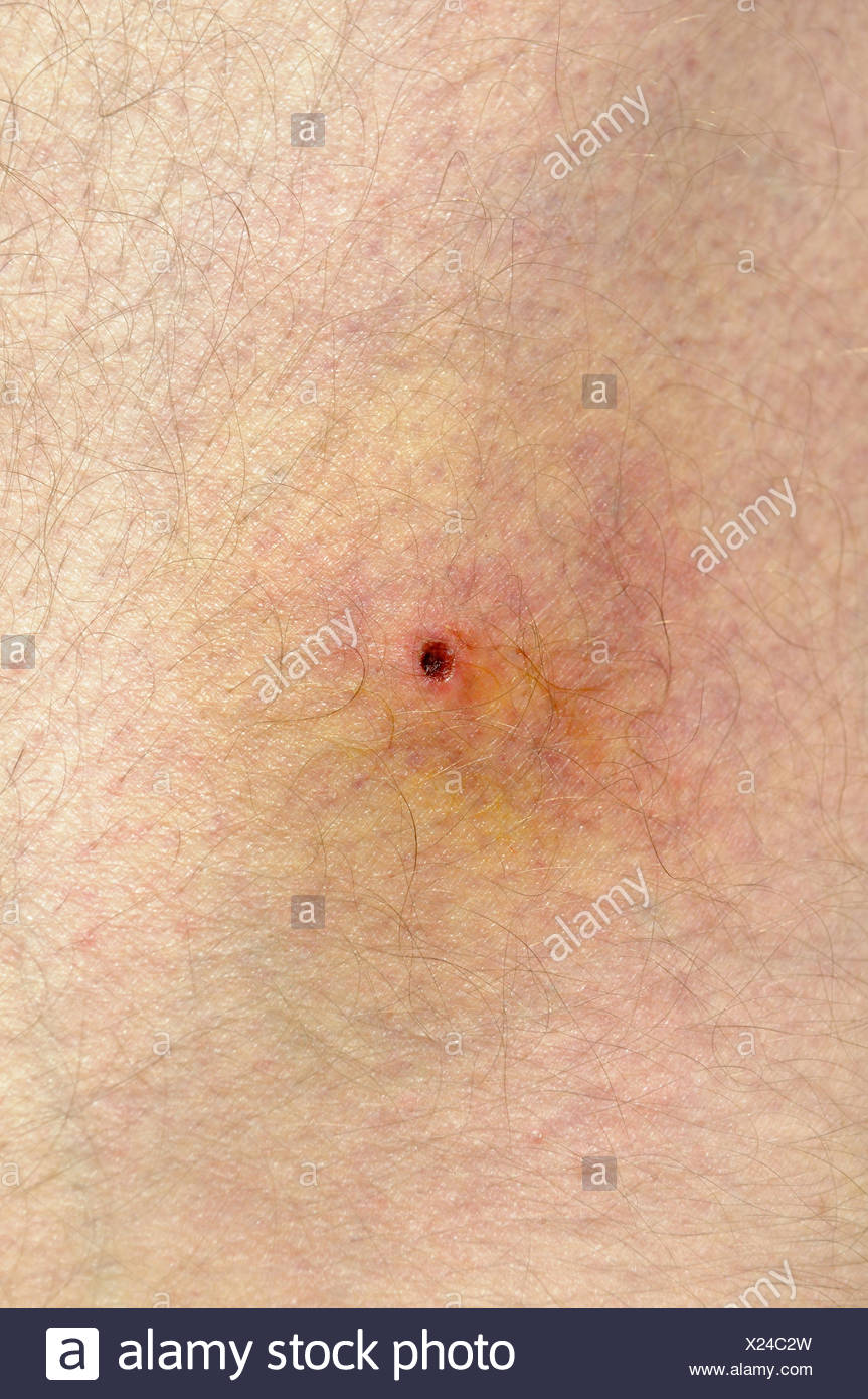Zeckenbiss Stockfotos & Zeckenbiss Bilder Alamy