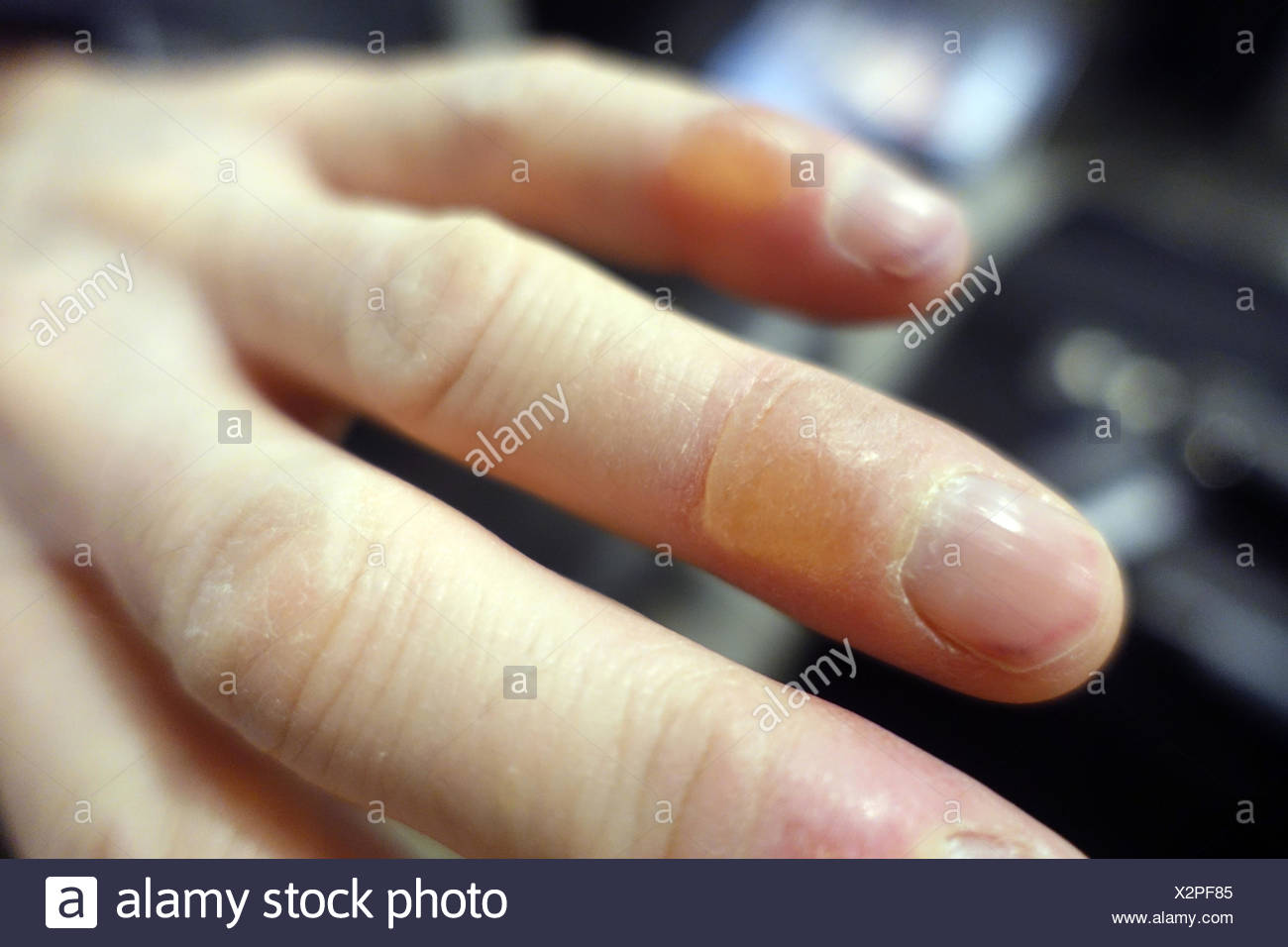 Frostbeulen Stockfotos & Frostbeulen Bilder - Alamy