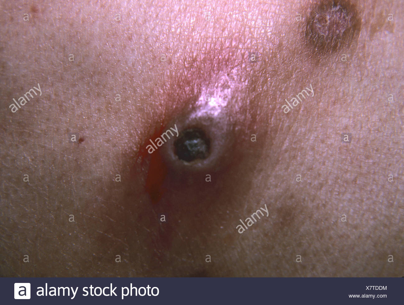 Varicella Zoster Infection Stockfotos Varicella Zoster Infection