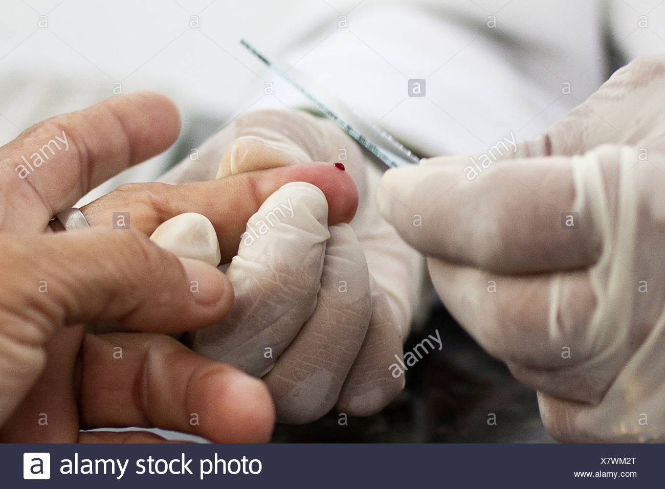 Blutentnahme Mit Finger Stick Fur Malaria Diagnostische Labortest Bei Amazonas Tropical Medicine Foundation Brasilien Stockfotografie Alamy