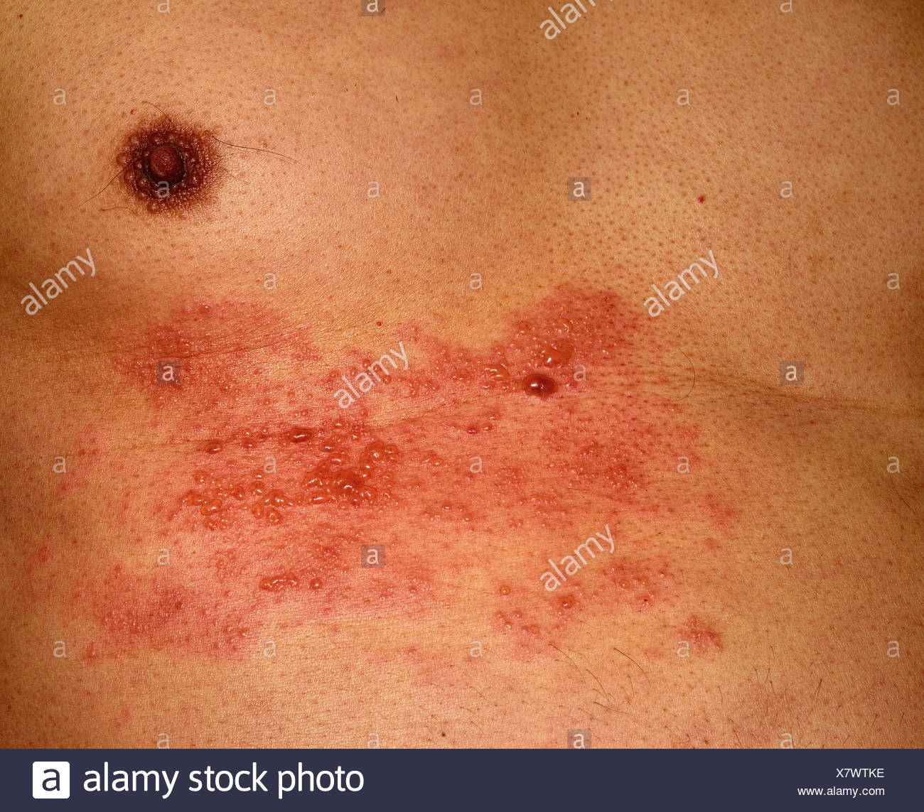 Herpes zoster Stockfoto, Bild 280236642 Alamy