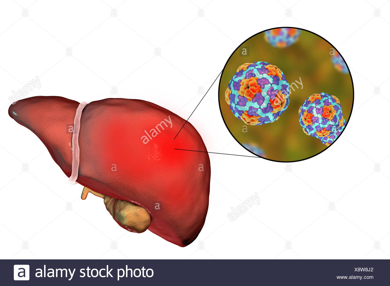 Leber Mit Hepatitis Und Nahaufnahme Blick Auf Hepatitis A Viren Abbildung Hepatitis A Wird Durch Infizierte Speisen Oder Getranke Ubertragen Symptome Grippeahnliche Symptome Wie Fieber Und Krankheit Zusammen Mit Gelbsucht Stockfotografie Alamy