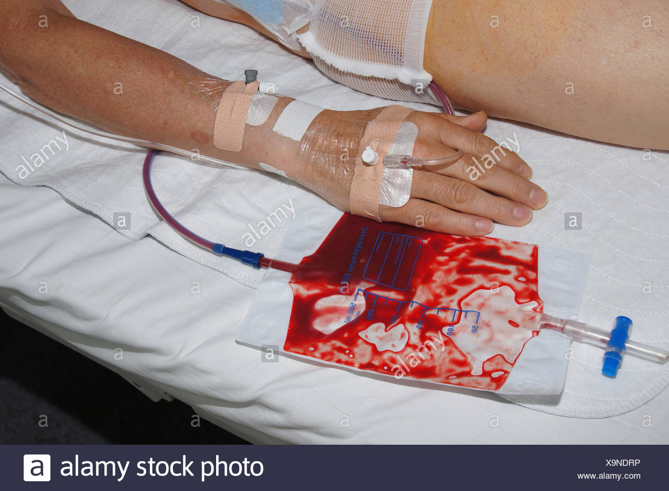 Bauch Krebs Stockfotos und bilder Kaufen Alamy