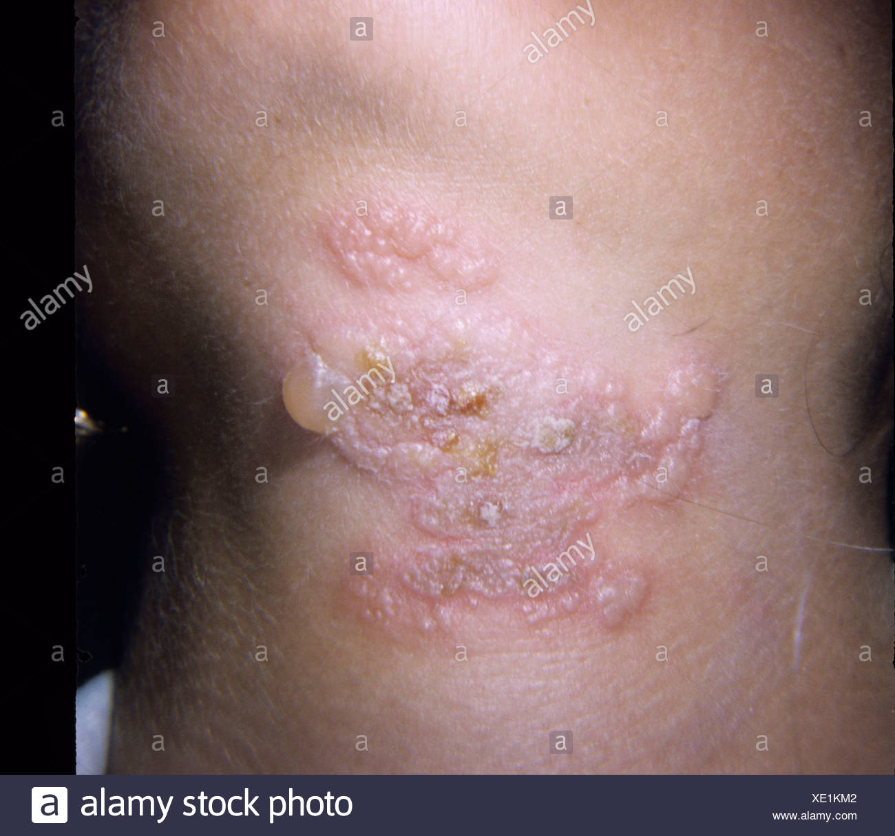 Herpesvirus Hominis Stockfotos und -bilder Kaufen - Alamy