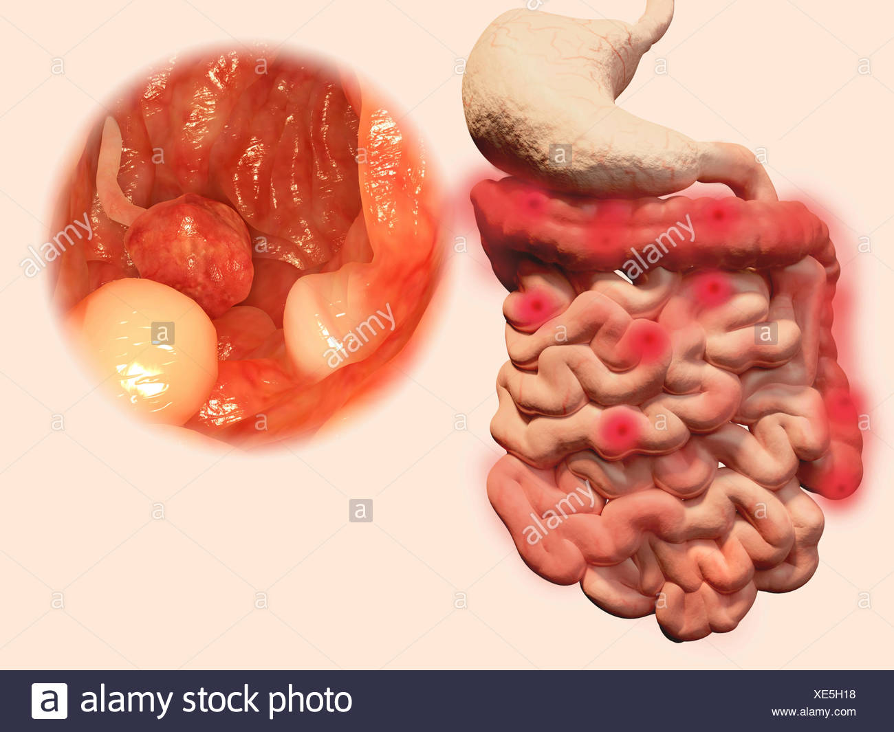 Darmpolypen Computer Bild Polypen Sind Eine Abnorme Wachstum Von Gewebe Obwohl Gutartig Nicht Krebsartige Gibt Es Eine Stockfotografie Alamy