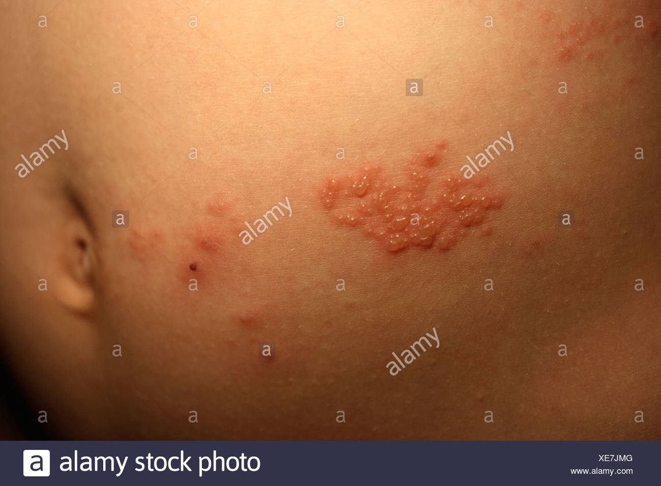 Gürtelrose (Herpes Zoster) am Oberkörper, Herpes, Viruserkrankung