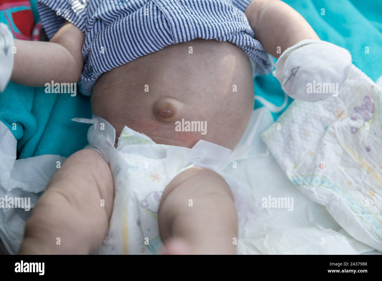 Bebe Recien Nacido Ombligo Romper Hernia En Los Bebes Los Bebes Ombligo Fotografia De Stock Alamy