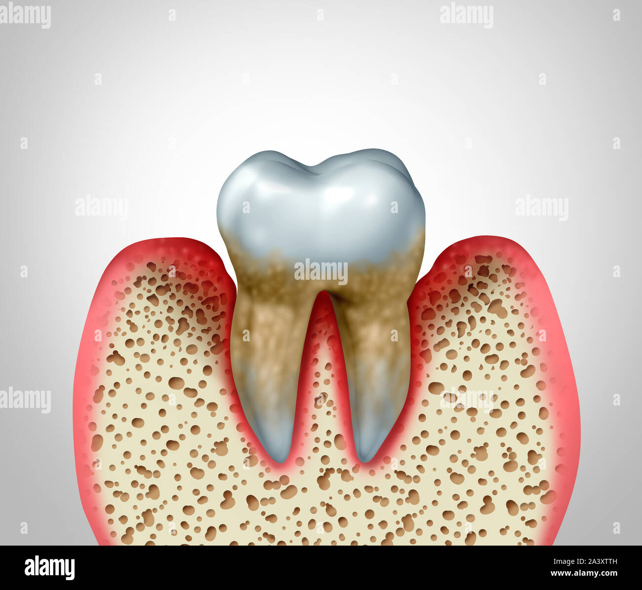 Periodontitis la enfermedad de las encías y dientes bucodental deficiente higiene de la salud el problema como una infección bacteriana con inflamación concepto diagrama 3D como una ilustración. Foto de stock