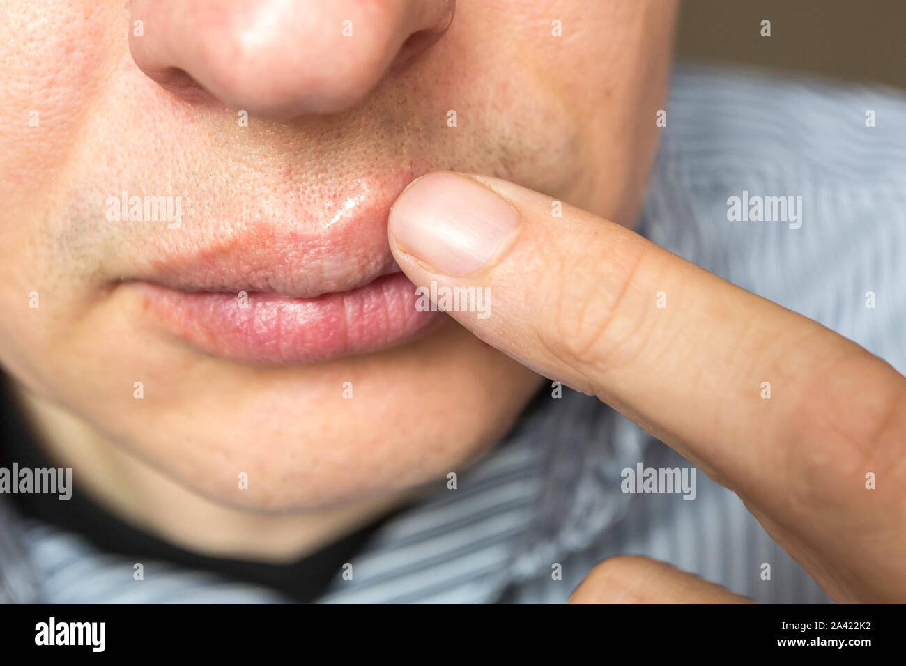 Inflamación roja y el virus herpes zoster en labio macho superior  Fotografía de stock - Alamy