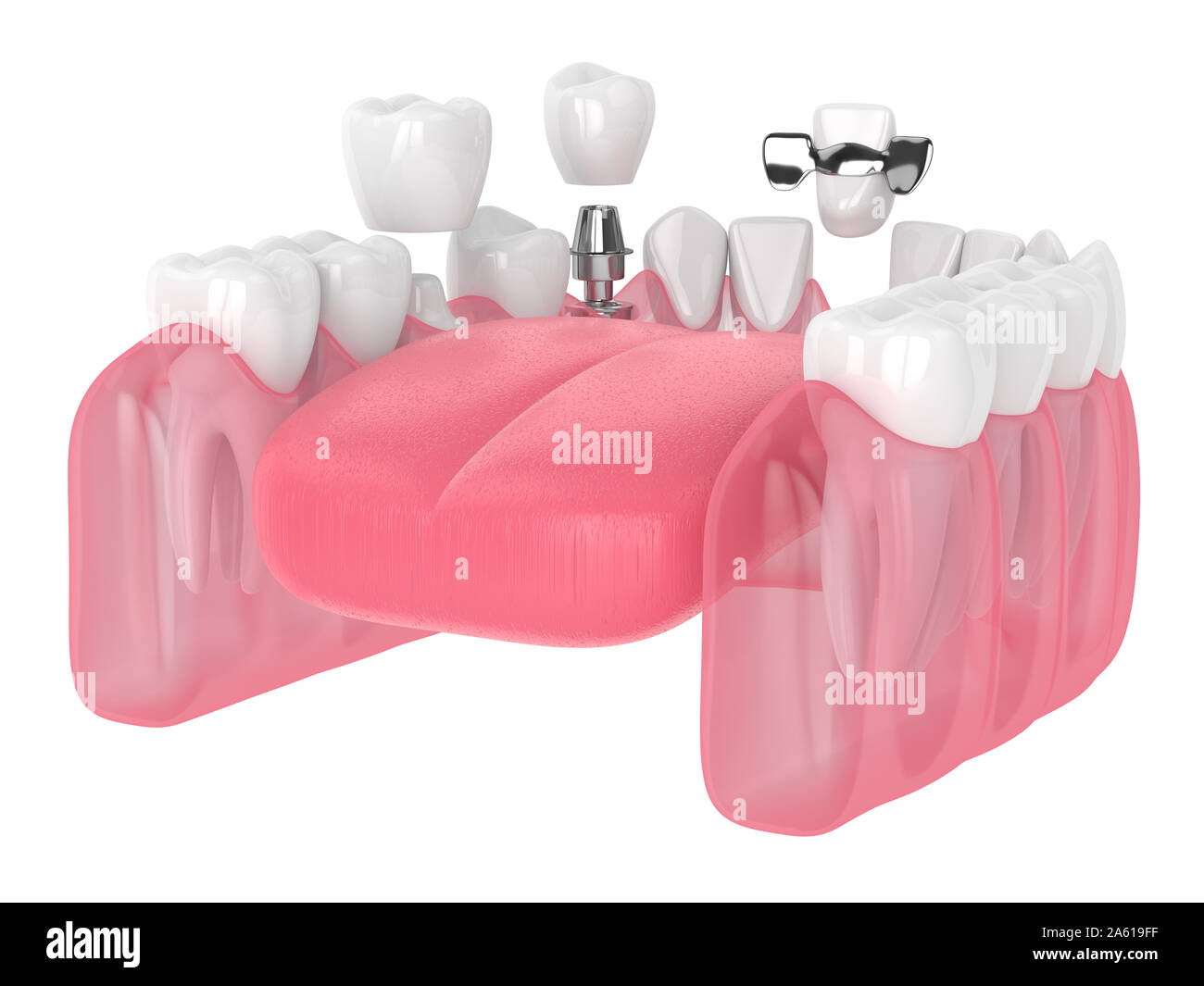 3D Render de mandíbula con implantes dentales y puentes sobre fondo