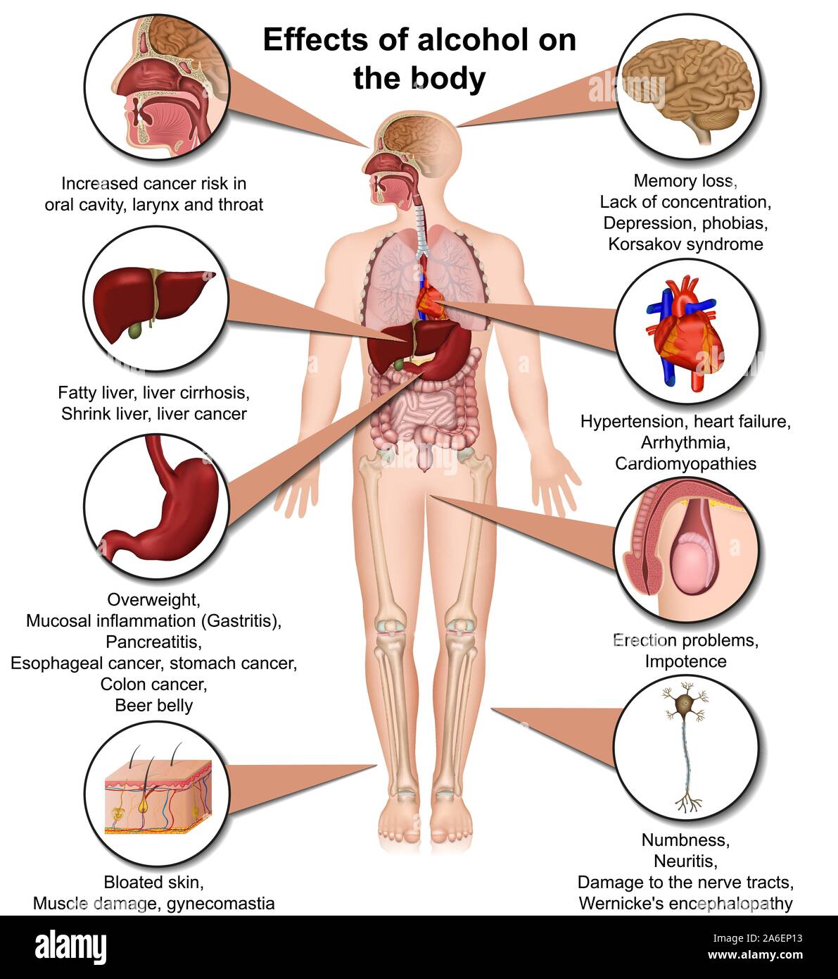 Efectos del alcohol en el cuerpo médico en 3D ilustración vectorial