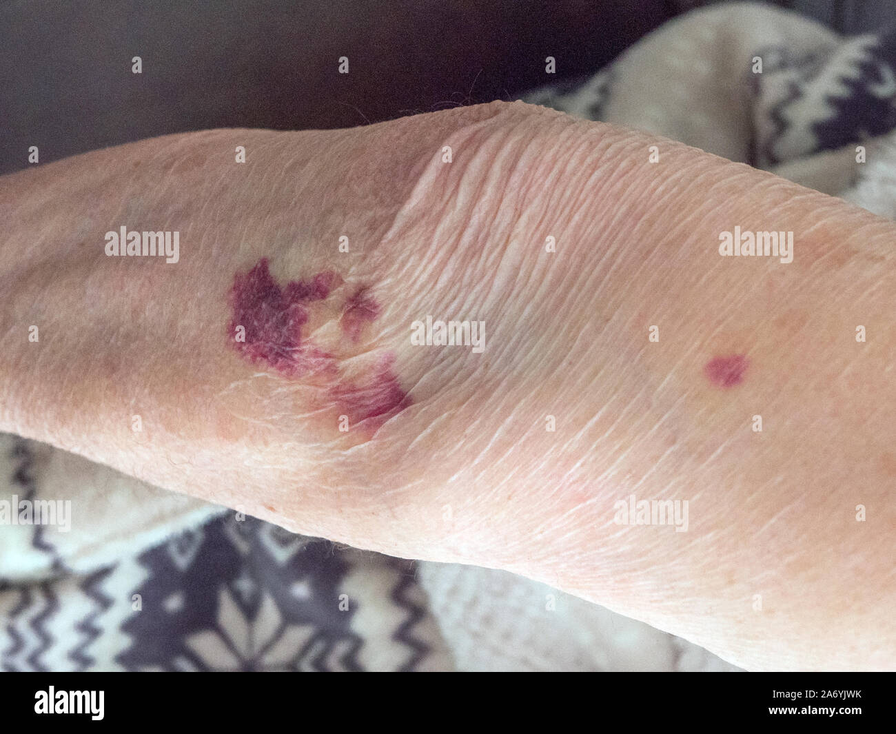 Cerca de la mancha de sangre y magulladuras en la hembra madura del