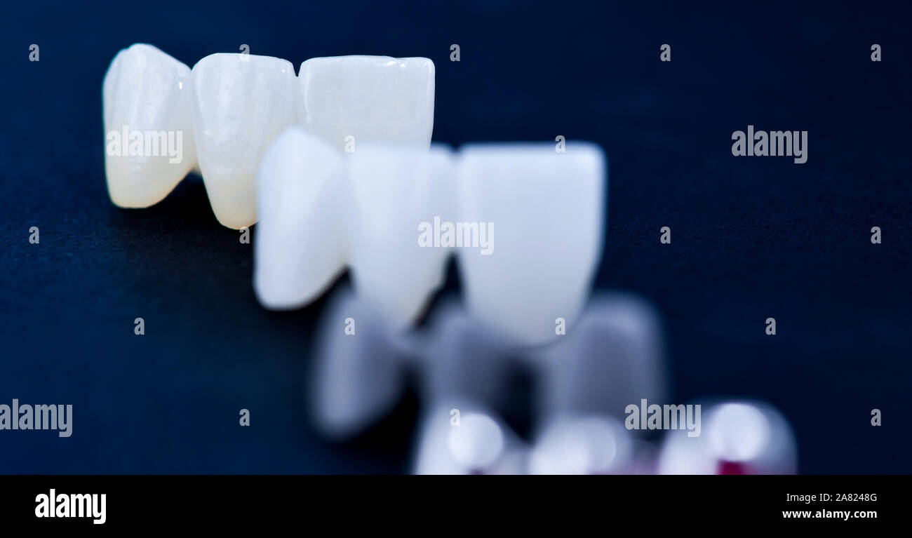 Los diferentes tipos de coronas dentales dental aislado sobre fondo