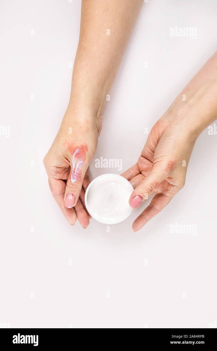 Crema para la dermatitis fotografías e imágenes de alta resolución - Alamy