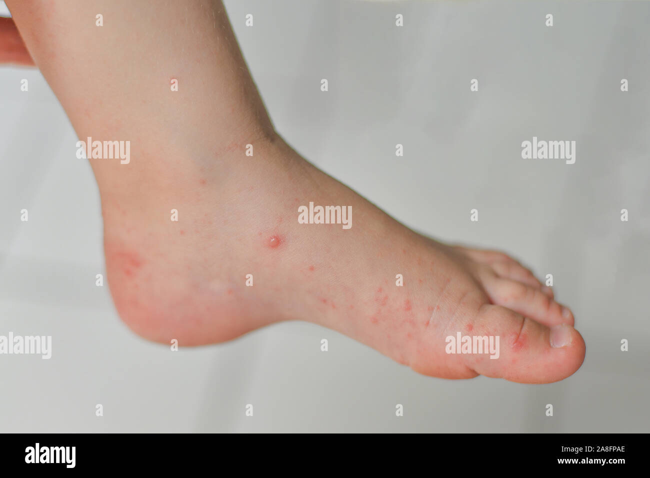 Coxsackie virus fotografías e imágenes de alta resolución Alamy