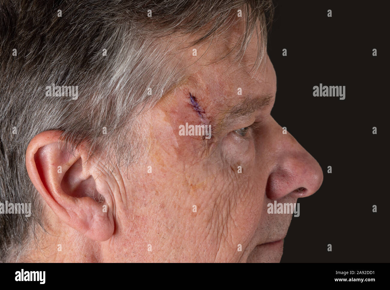 Senior masculino adulto con puntos de sutura en la corte después de la cirugía para la extirpación de un carcinoma de célula basal causada por el daño solar Foto de stock