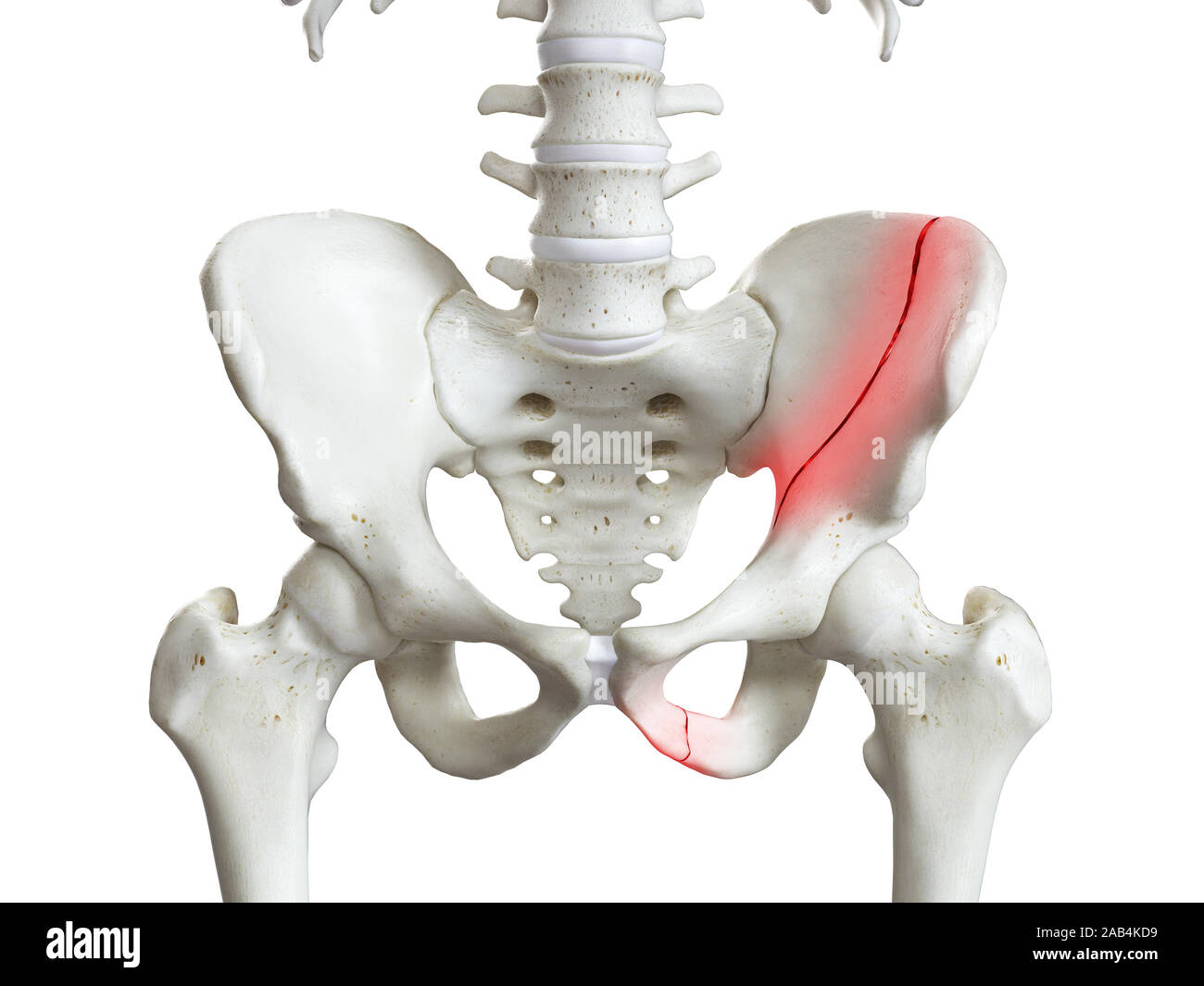 3D prestados ilustración médica precisa de una fractura de pelvis Foto de stock