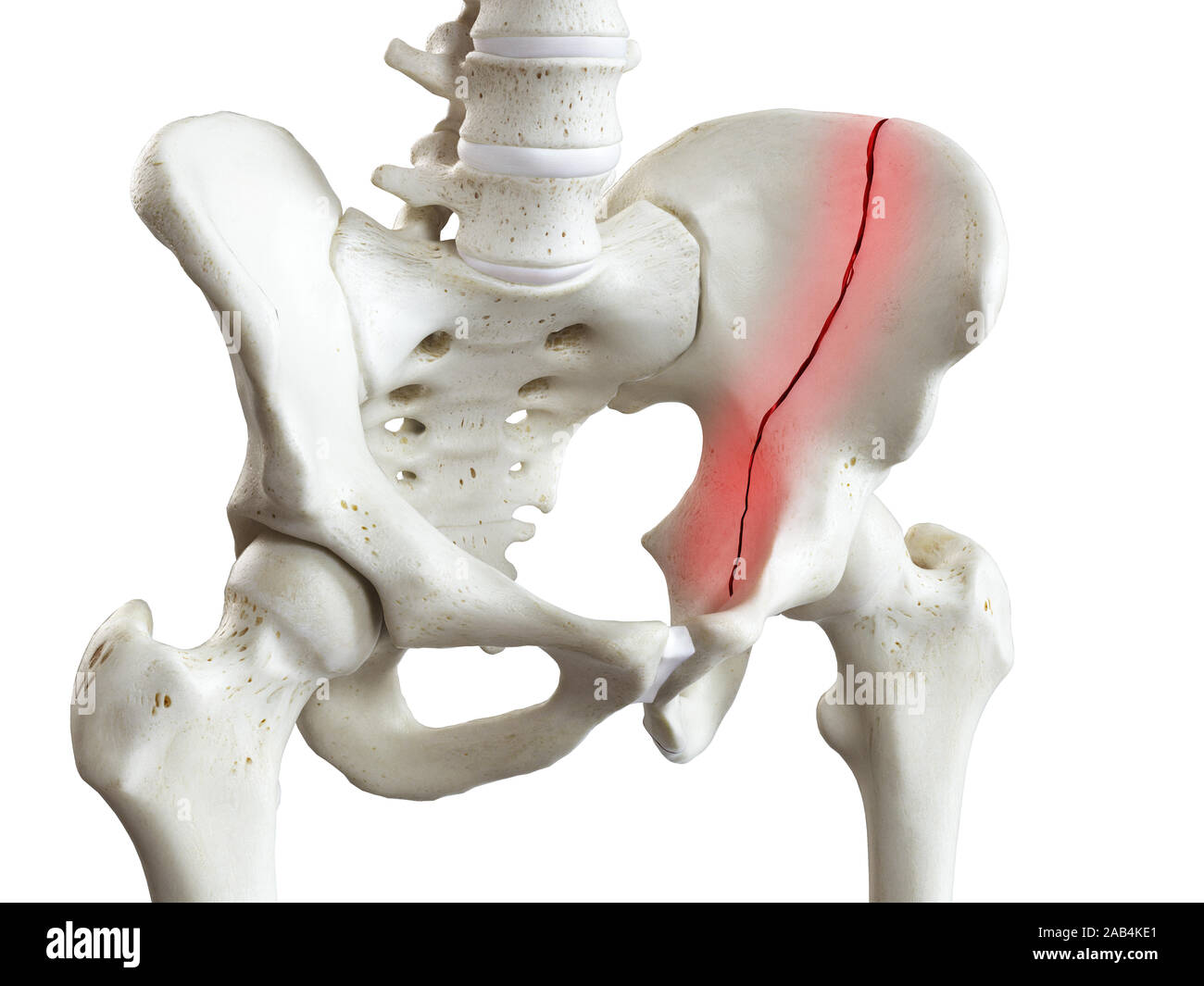 3D prestados ilustración médica precisa de una fractura de pelvis Foto de stock