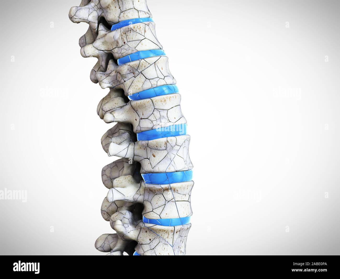 3D prestados ilustración médica precisa de una fractura de columna Foto de stock