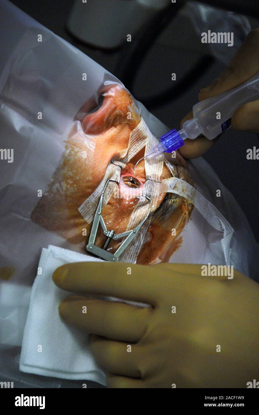 La cirugía del ojo con láser. Cirujano llevar a cabo la cirugía refractiva  con láser excimer en ojos del paciente. Láser excimer la cirugía refractiva  se utiliza un láser excimer Fotografía de