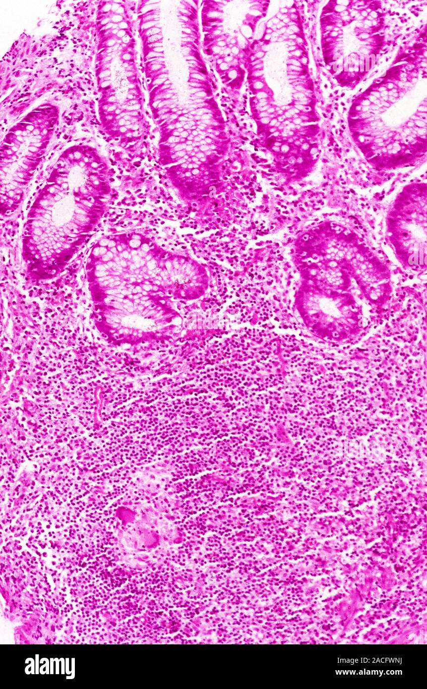 La enfermedad de Crohn. Luz micrografía de una sección a través de un