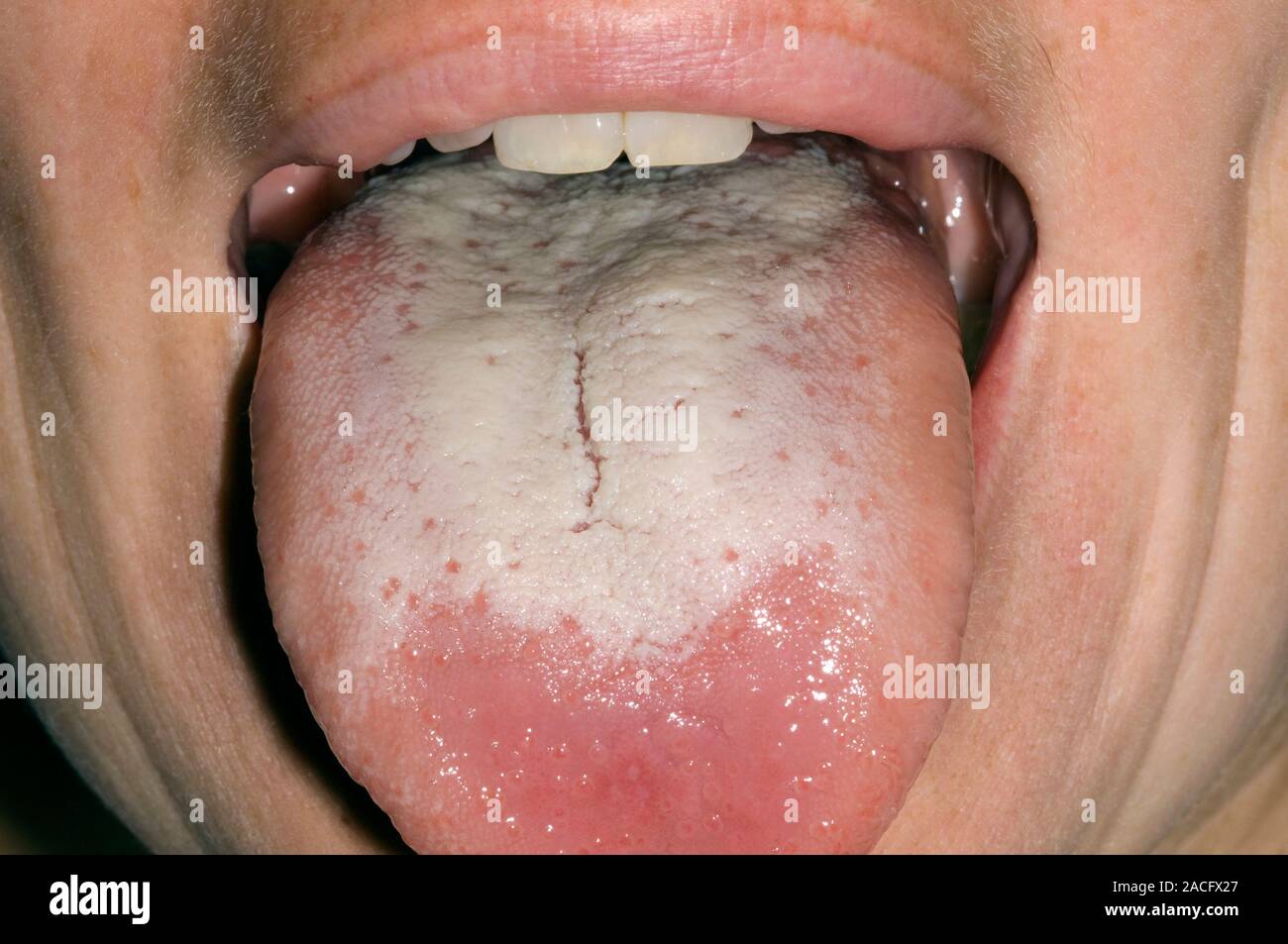 La candidiasis oral infección fúngica de la lengua (placas) de color blanco  y la boca en una paciente mujer adulta siguientes medicamentos antibióticos  tomados para cirugía de la vejiga Fotografía de stock -