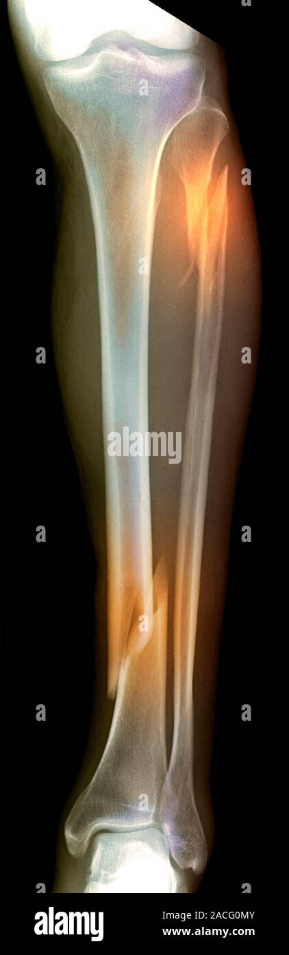 Rayos X de color (vista posterior) de la pierna de un paciente, mostrando  una doble fractura en la parte inferior de la pierna en la que el peroné  proximal (parte superior derecha)