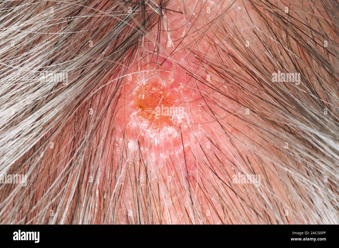 Cerca del cuero cabelludo del anciano, mostrando el carcinoma de células  escamosas (cáncer de piel). Este segundo tipo más común de cáncer de piel  afecta a la up Fotografía de stock -