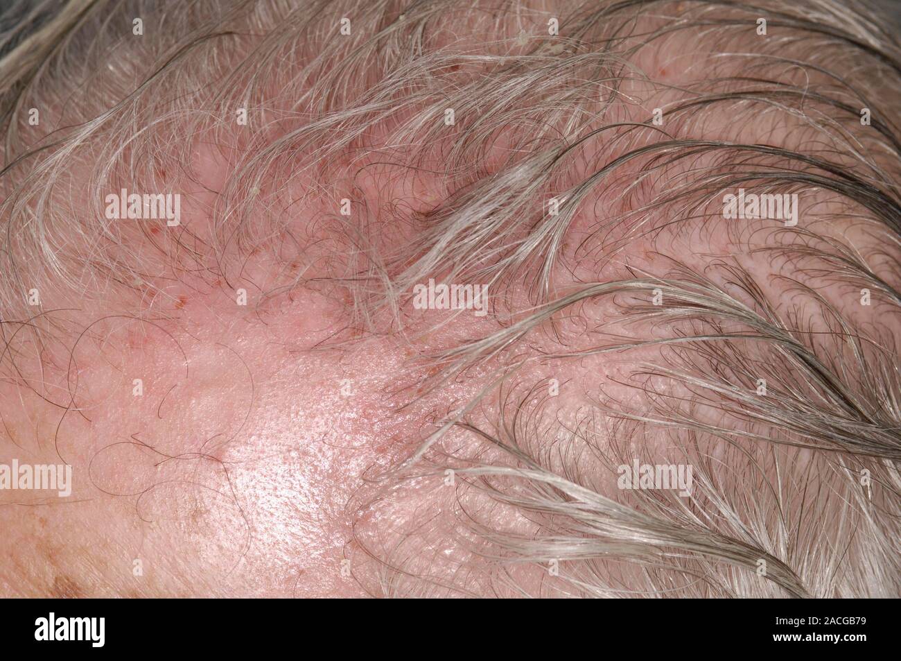 La irritación del cuero cabelludo en un paciente masculino de 81 años de  edad, después de un herpes zóster erupción (neuralgia post herpética). La  culebrilla o herpes zoster es una enfermedad caus