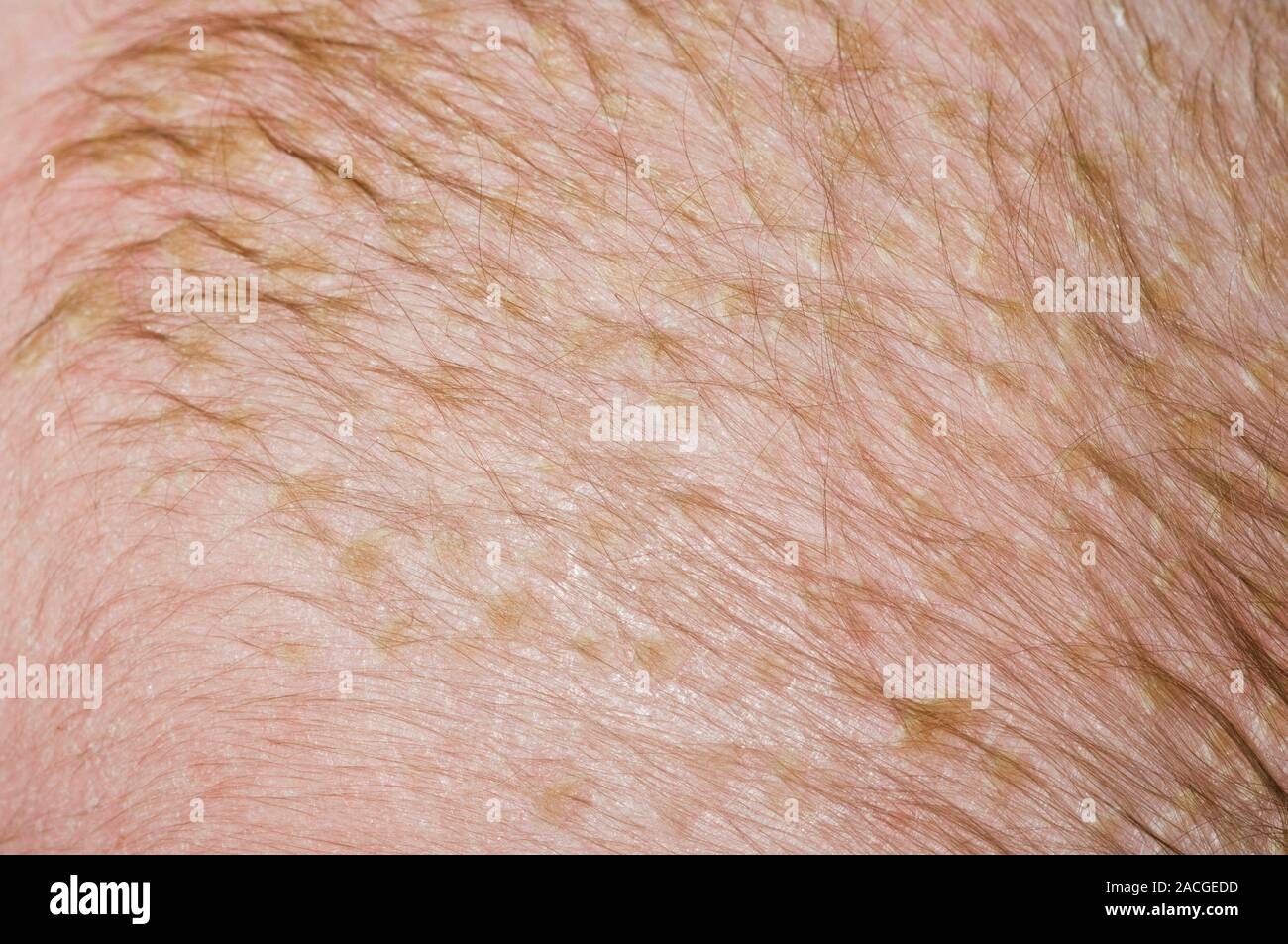 Escamas de piel en el cuero cabelludo del paciente varón de seis meses  debido a la costra láctea (crusta lactea). Estas escamas amarillas en la  cabeza son una forma de seborreica Fotografía