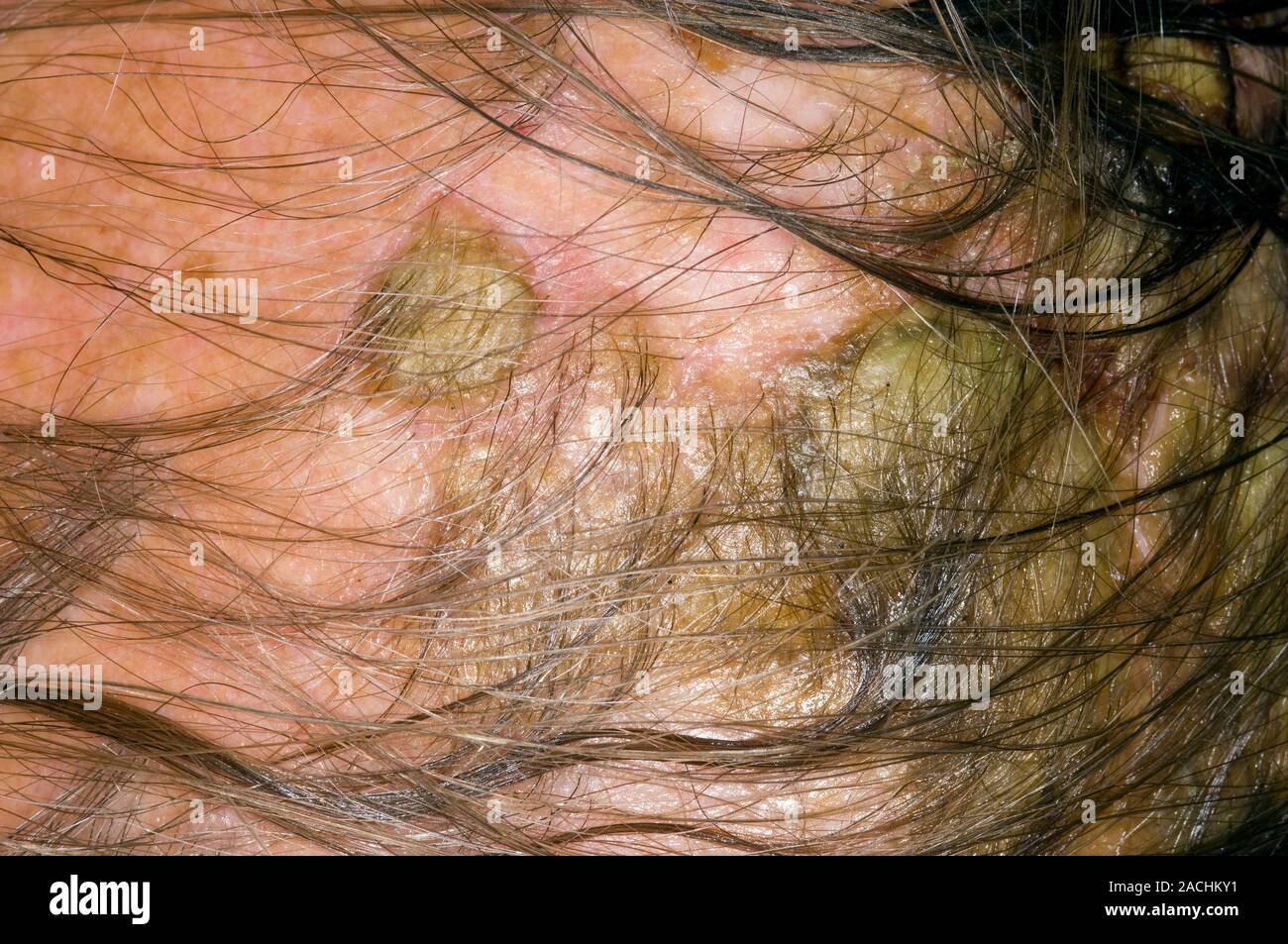 Close-up de la escala en el cuero cabelludo en un paciente masculino de 63  años con eczema seborreico. Eczema seborreico es un tipo de inflamación  cutánea (dermatitis) cau Fotografía de stock -