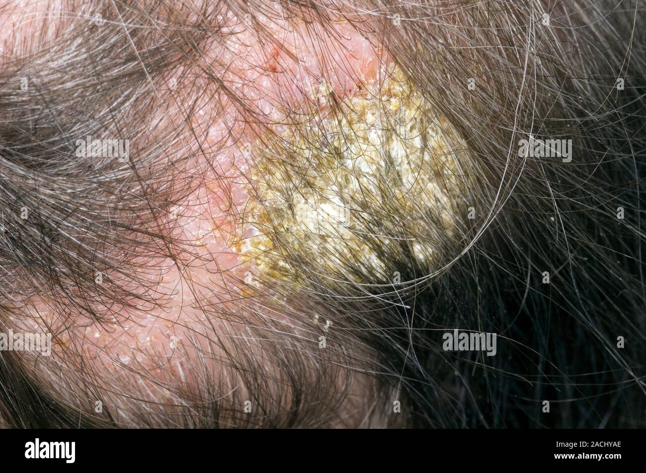 Close-up de eccema infectado en el cuero cabelludo de la cabeza en un alcohólico, de 70 años, paciente que se descuida a sí misma. eccema es una condición común de la