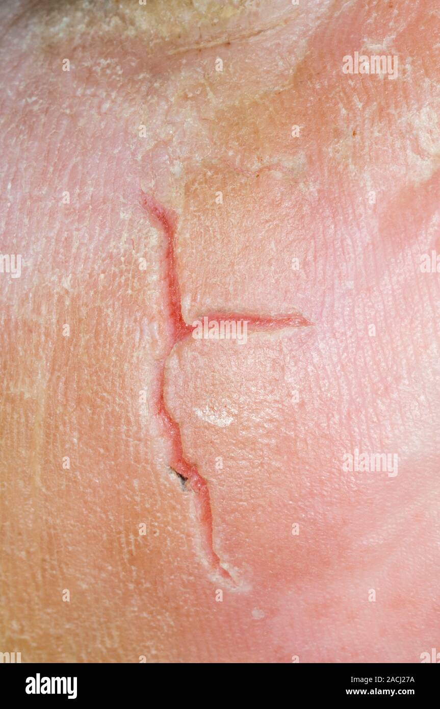 Closeup de una profunda fisura (crack) en la piel sobre el talón del
