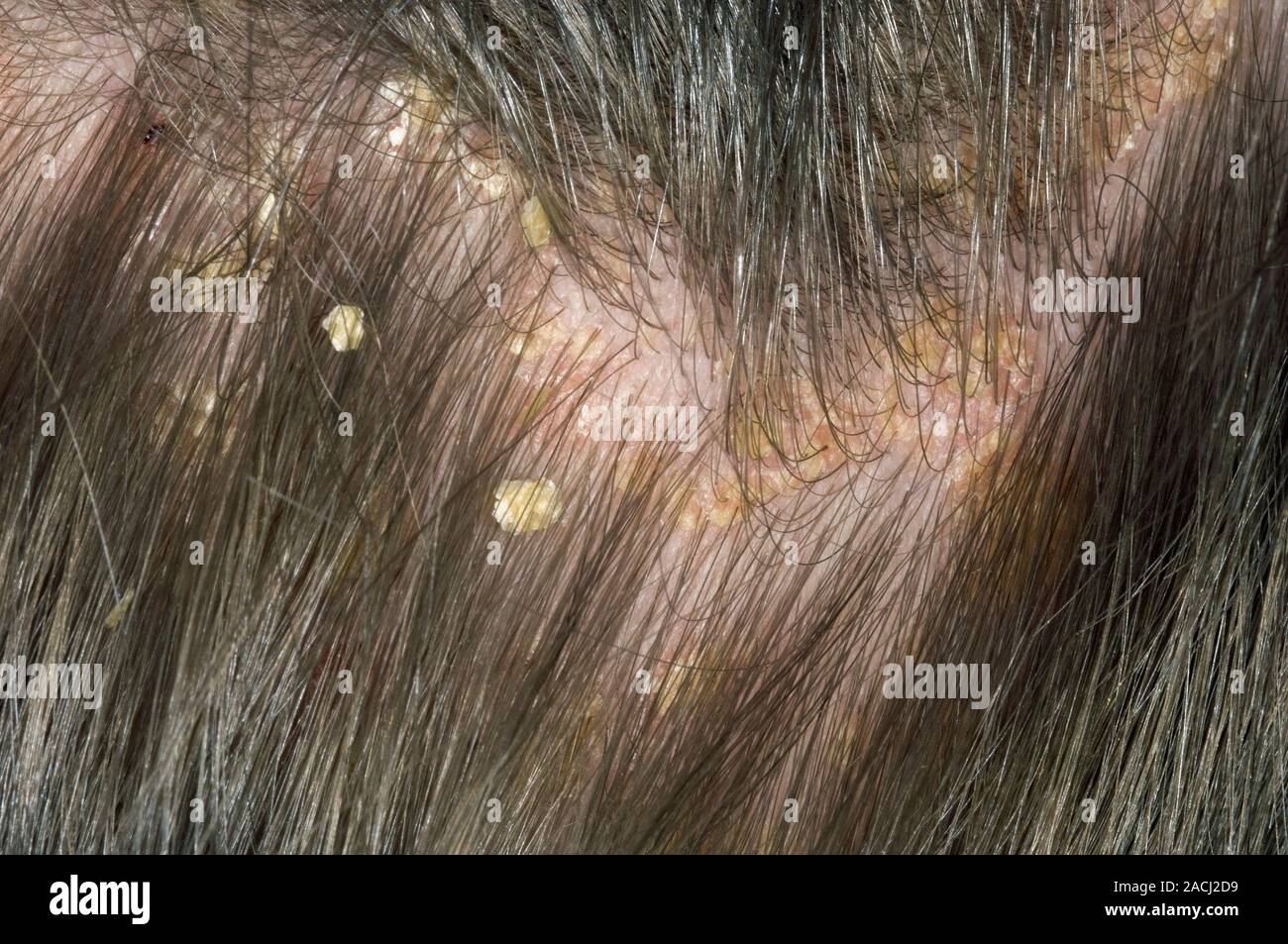 Descamación descamación de la piel y en el cuero cabelludo en un paciente  masculino de 4 años debido a la psoriasis. Psoriasis se produce cuando las  nuevas células de la piel se