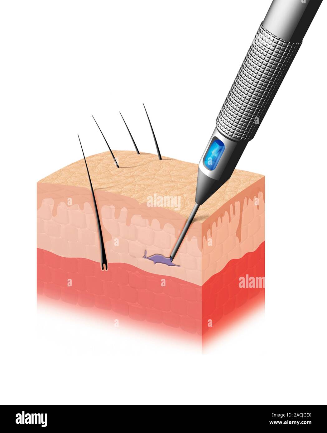 Tatuaje. Equipo arte de una aguja de tatuaje inyectando tinta en la piel.  Un tatuaje se realiza insertando una tinta permanente en la dermis (capa  inferior Fotografía de stock - Alamy