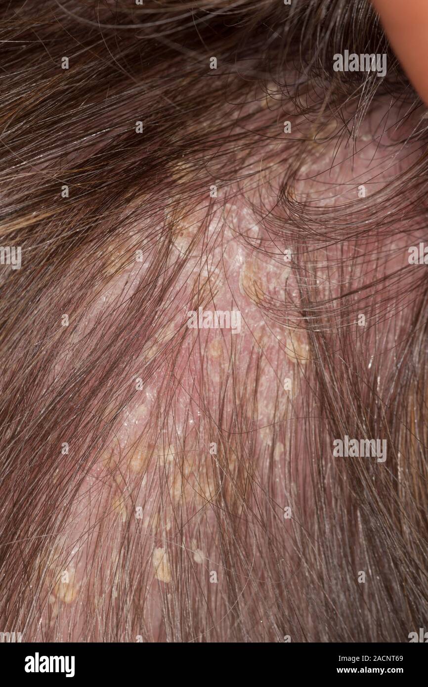 La psoriasis de la piel del cuero cabelludo en una paciente femenina de 60  años de edad. La psoriasis es una afección de la piel donde el excesivo  crecimiento de la piel