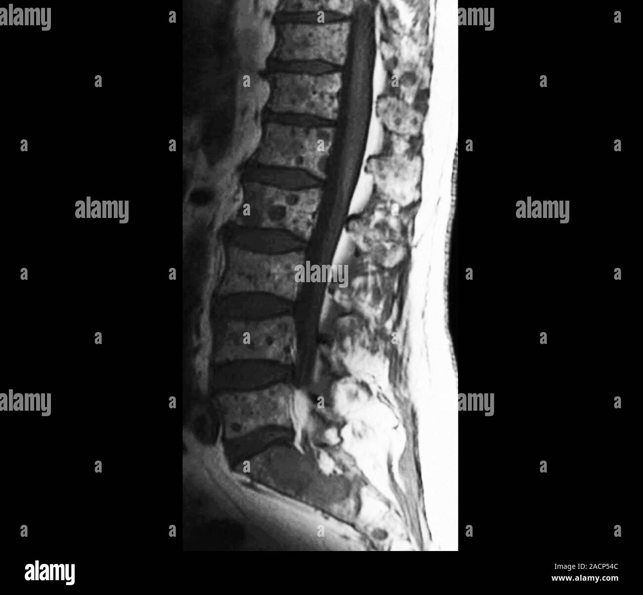Cáncer medular. Imágenes por resonancia magnética (IRM) de una sección a  través de la región lumbosacra de la columna vertebral de un 64-año-viejo  paciente femenino, mostrando Fotografía de stock - Alamy